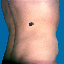 Example of skinCancerAndMelanomas